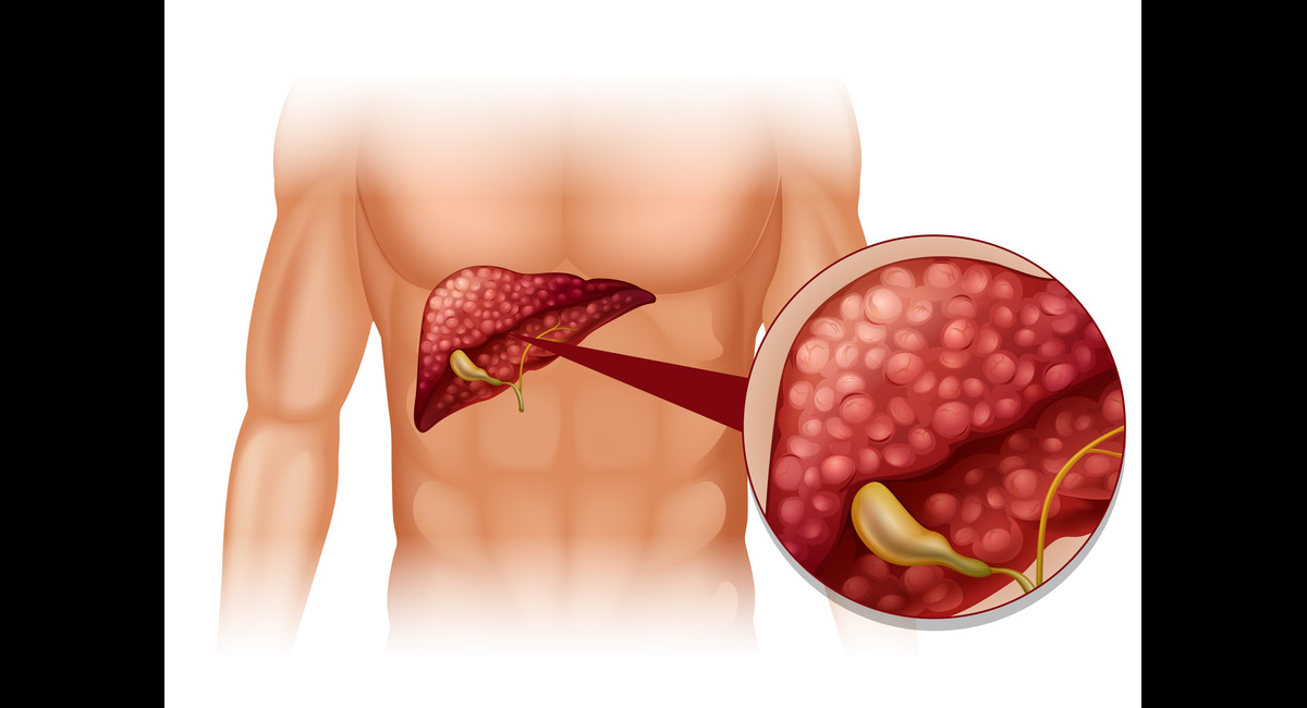 Which Size of Gallbladder Stone is Dangerous?