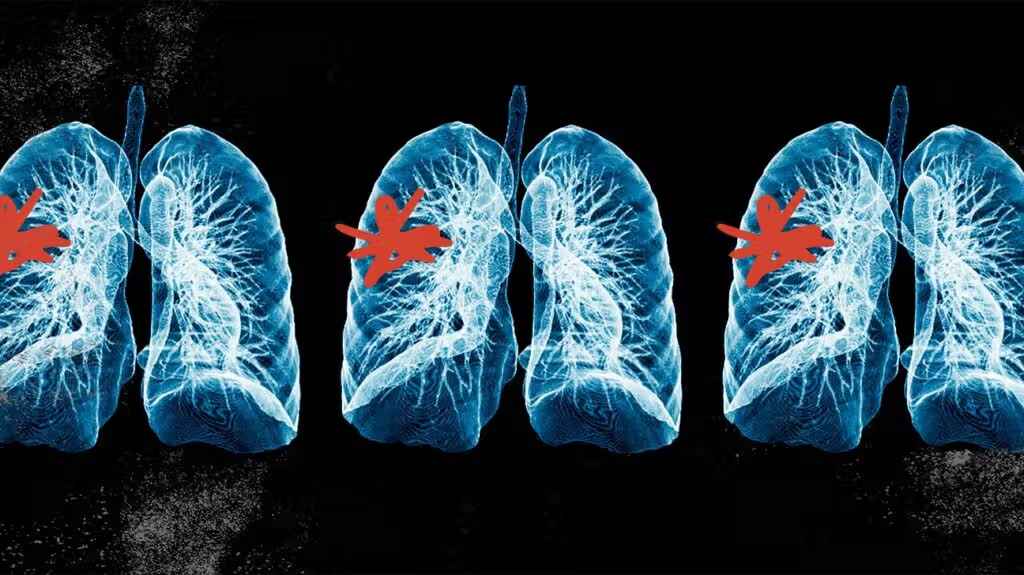 COPD vs Asthma