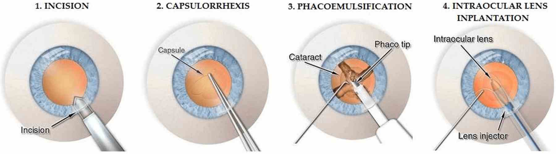 Cataract Surgery Cost – Pricing, Lenses & Procedures