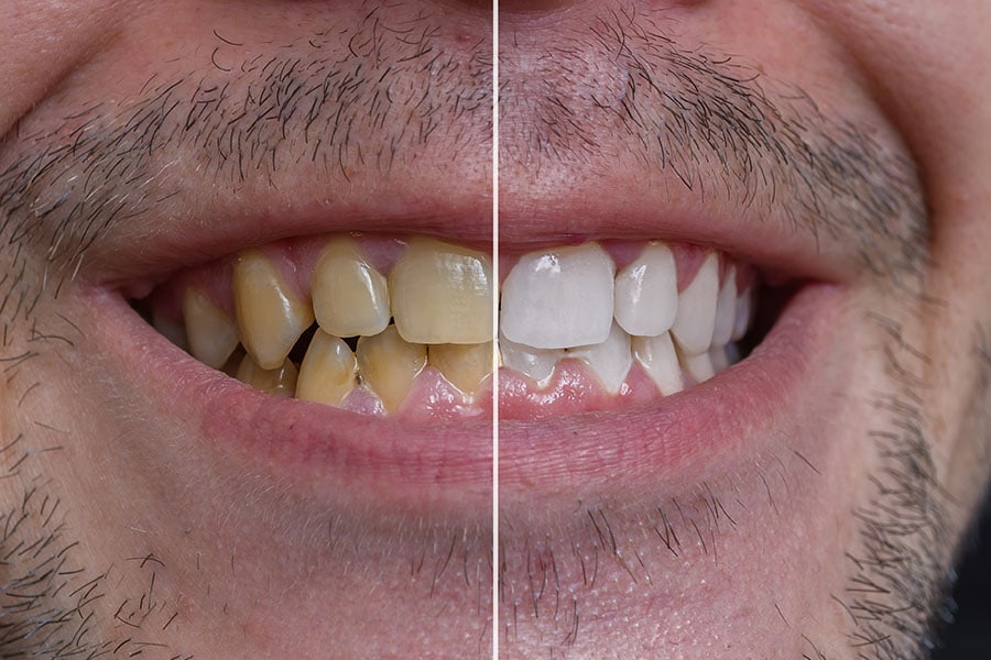 Get Rid of Yellow Teeth Naturally