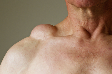Lipoma Removal Creams