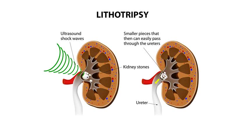 Lithotripsy Cost in India – Procedure, Benefits & Cost