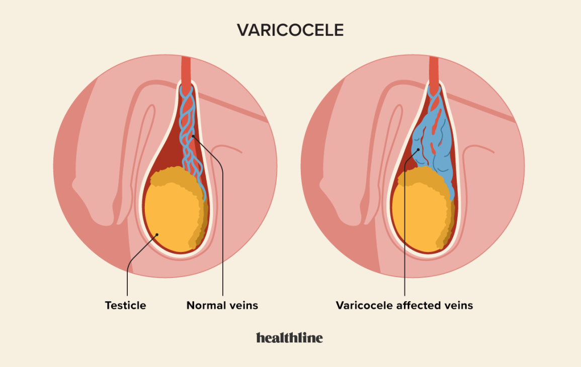 Varicocele Surgery Cost in India – Lowest Cost