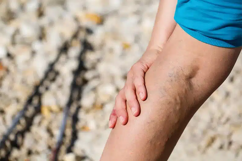 Varicose Veins Treatment