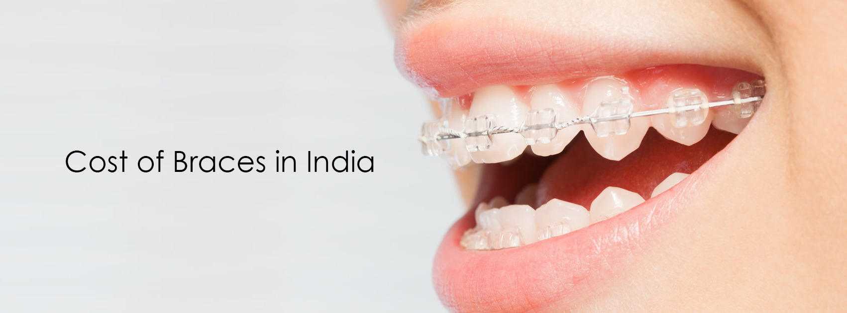 Cost of braces in india