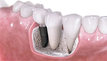 Dental Implants Cost in india