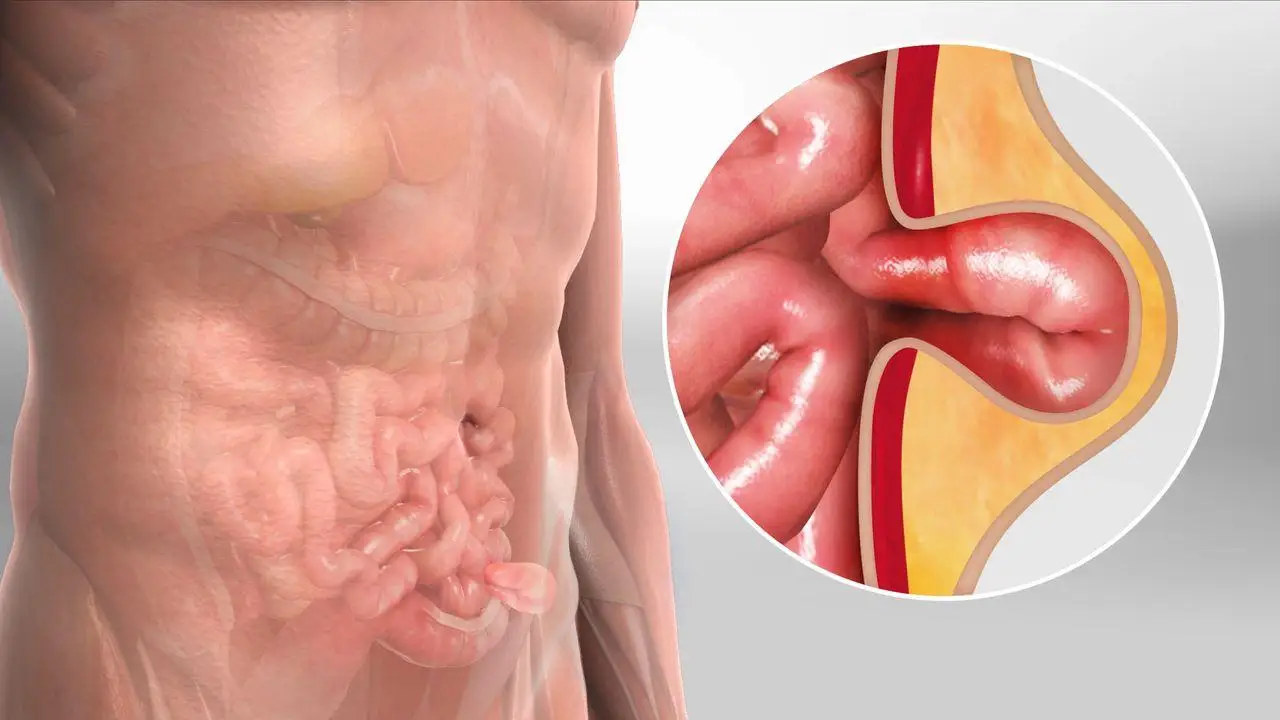 Hernia Image