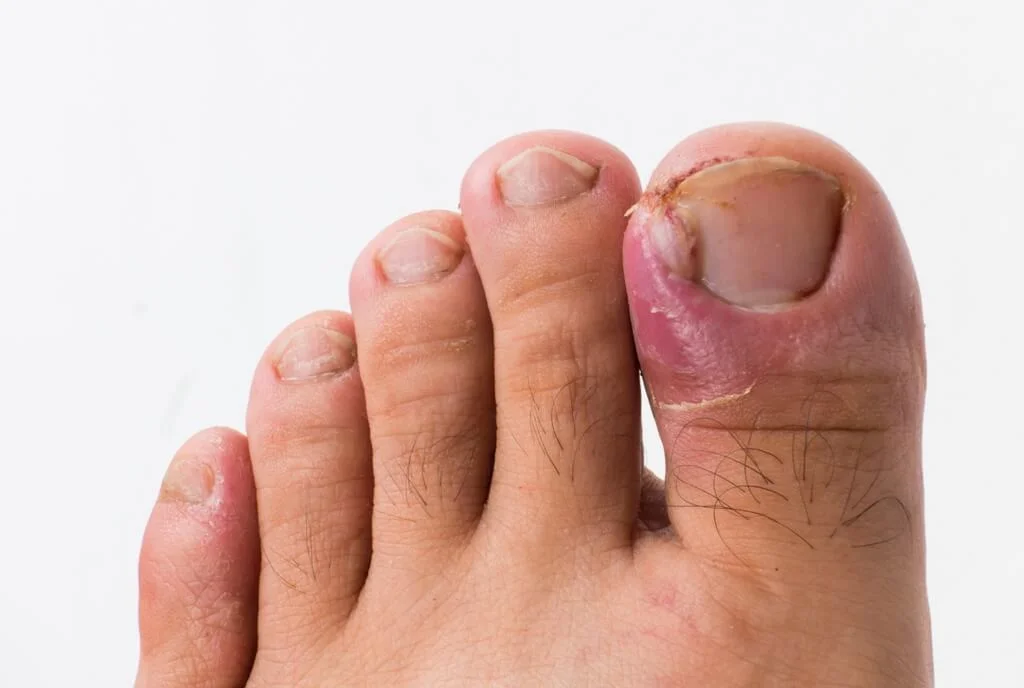 Toenail Removal Before and After