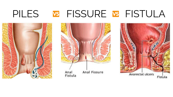 Piles vs Fissure vs Fistula – How to Identify?
