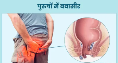 सिर्फ एक दिन में बवासीर के मस्से सुखाने के उपाय – Hemorrhoids Treatment in Hindi