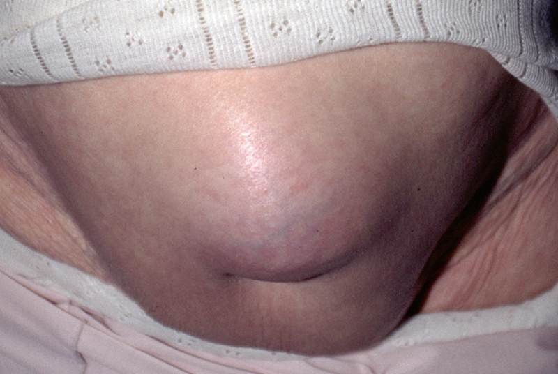 Hernia Operation Cost in India