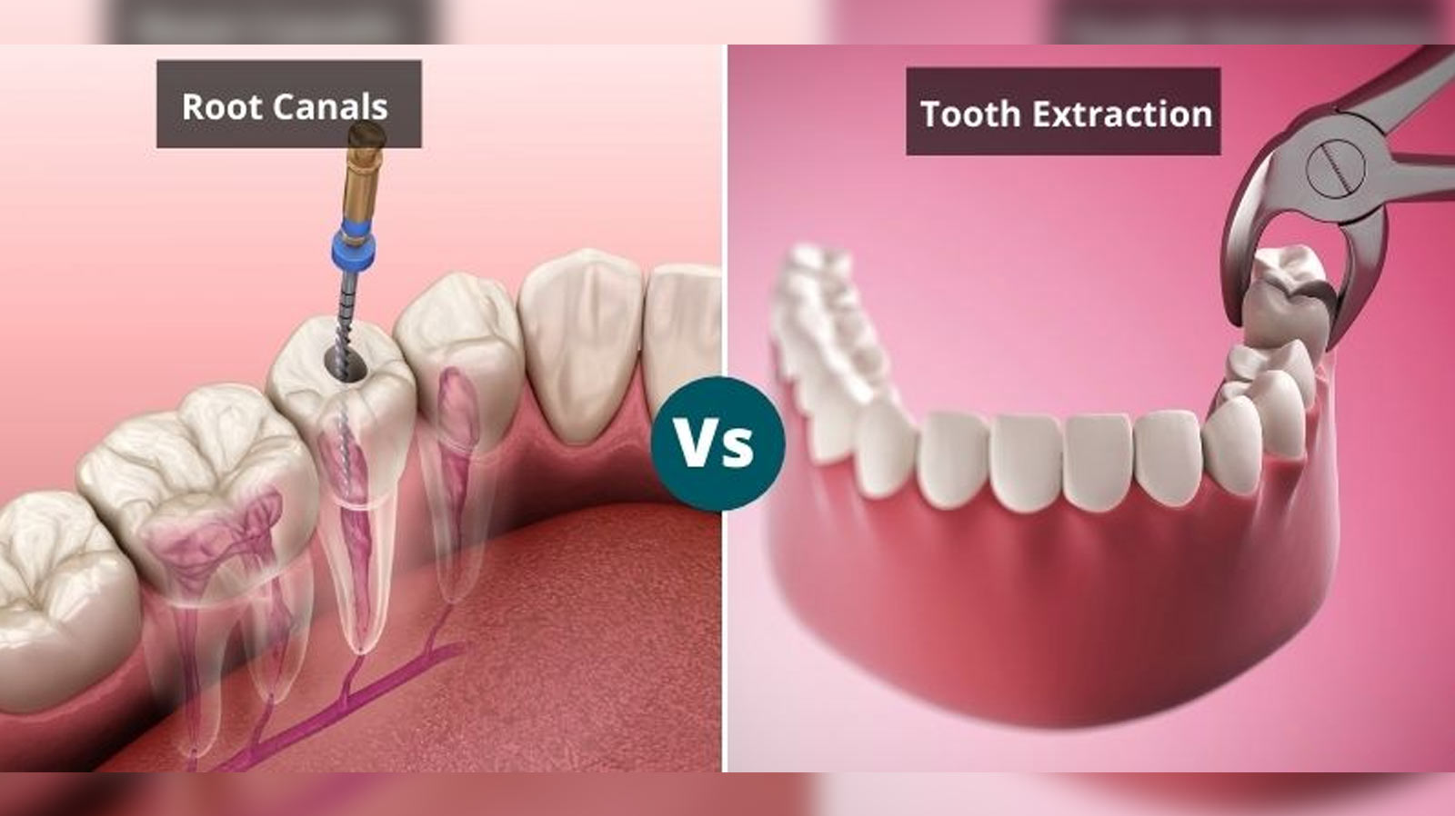 Root Canal vs. Tooth Extraction – Which Is Better for You?
