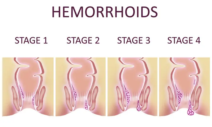 Hemorrhoids Grading