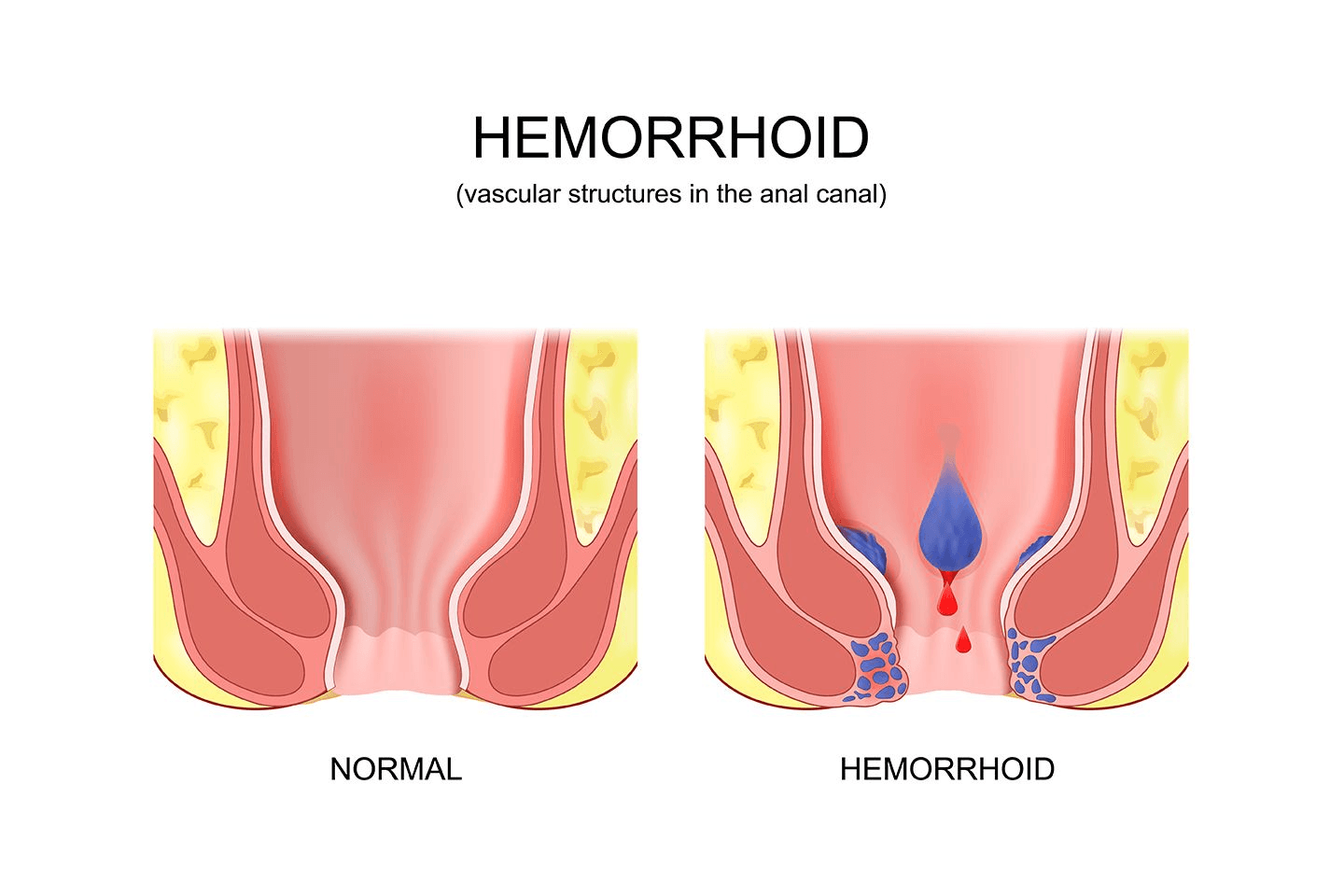 Piles Images – Real Photos, Types, Stages, Symptoms & Treatment