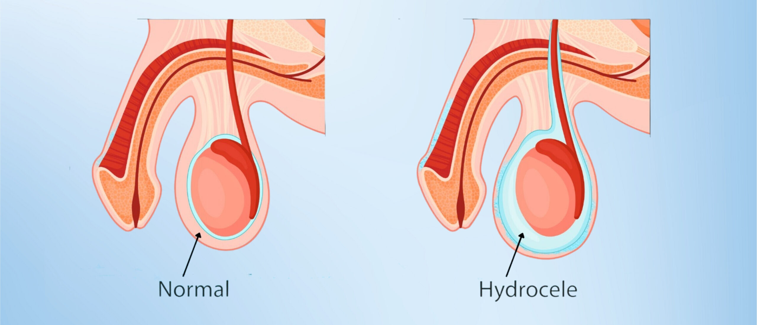 Hydrocele Surgery – Cost, Procedure, Recovery Time & Side Effects